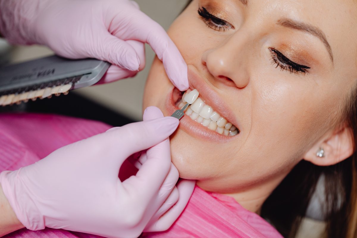 Dentiste : choisir une facette dentaire